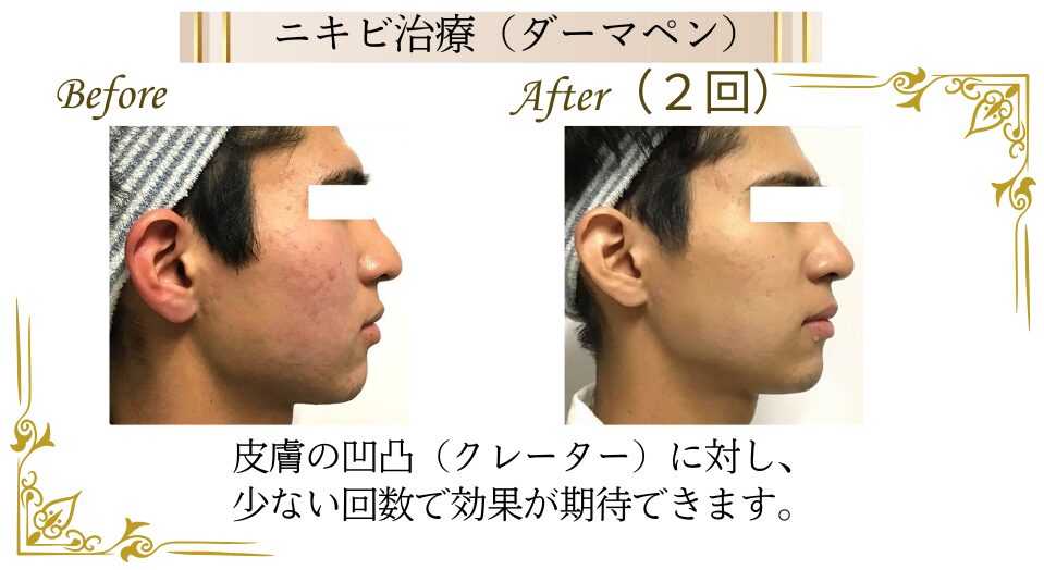 ダーマペンによる、ニキビ跡(クレーター)毛穴治療の症例
