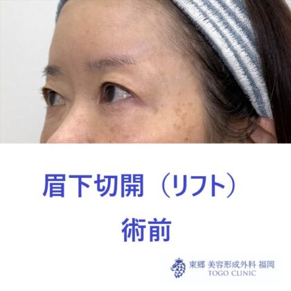 NK　眉下術前 (2)