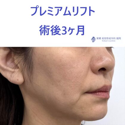 ME　糸リフト術後 (2)