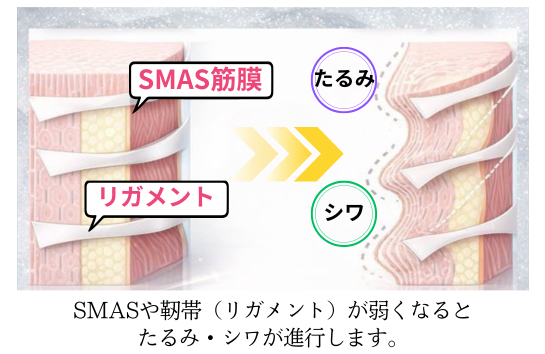 SMAS、靭帯が弱まり、たるみ・シワが進行