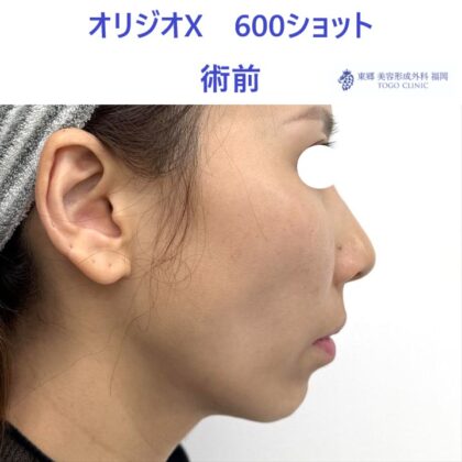 KN　オリジオ術前 (2)