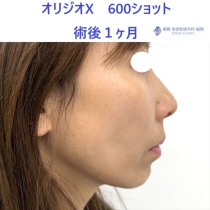 KN　オリジオ術後 (2)