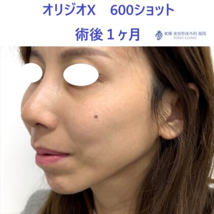 KN　オリジオ術後