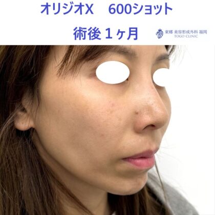 KN オリジオ術後