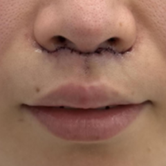 福岡で人中短縮（リップリフト）なら｜鼻の下を短くして「小顔」と「若見え」を叶える根本治療を解説