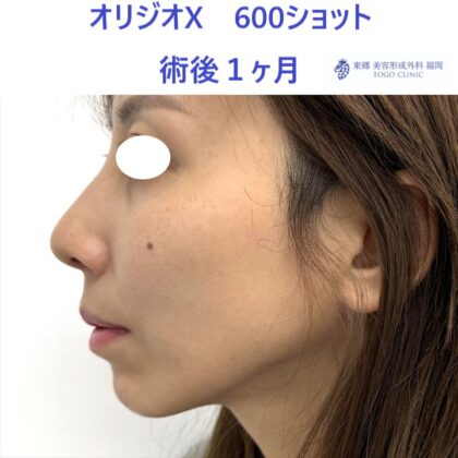 KN　オリジオ術後 (3)