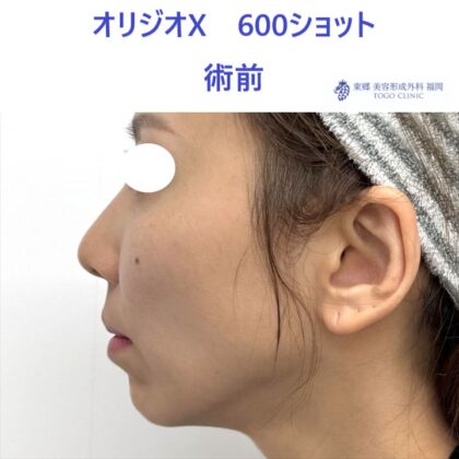 KN　オリジオ術前 (3)