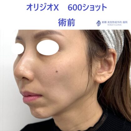 KN　オリジオ術前