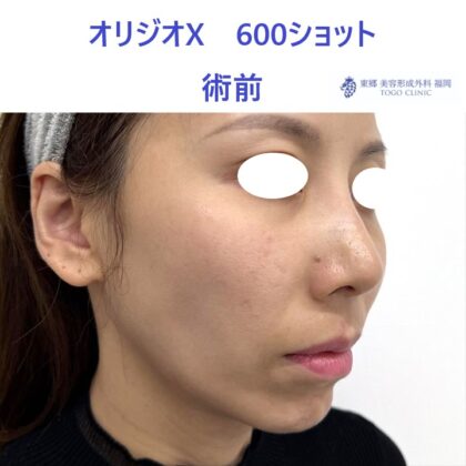 KN オリジオ術前