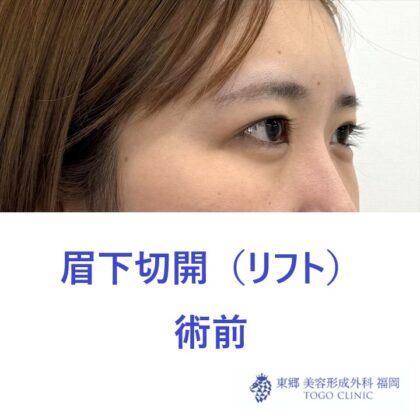 HT　眉下術前 (2)