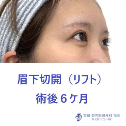 HT　眉下術後6M (2)