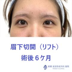 HT　眉下術後6M