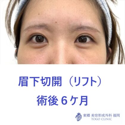 HT　眉下術後6M