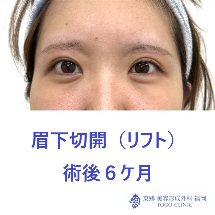 HT　眉下術後6M