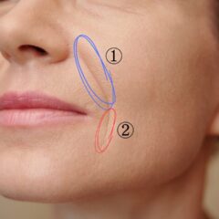 水光注射でほうれい線は改善できる？ほうれい線が気になり始めたら…まず知ってほしいこと