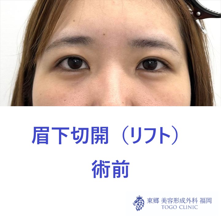 HT　眉下術前