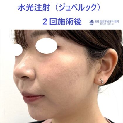 RKジュベルック　術後 (2)