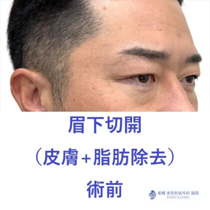 AT眉下　術前 (2)