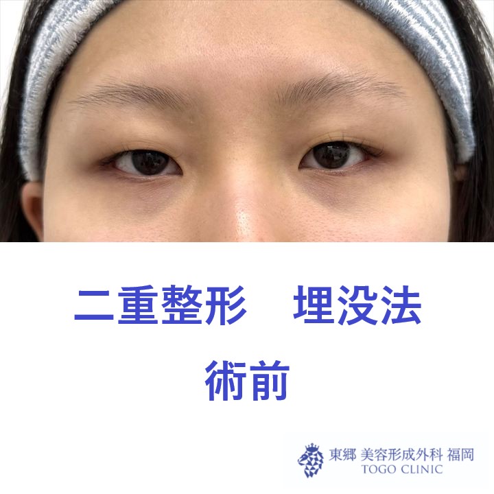 TH　埋没術前