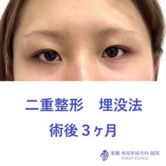 TH　埋没術後３Ｍ