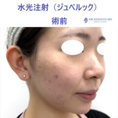 RKジュベルック術前