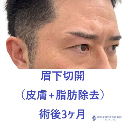 AT眉下　術後 (2)