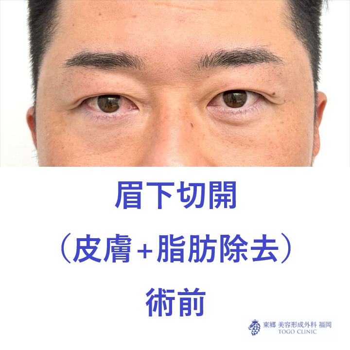 AT眉下　術前