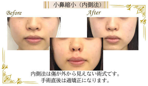 傷を目立たせず、小鼻を小さくする小鼻縮小の内側法