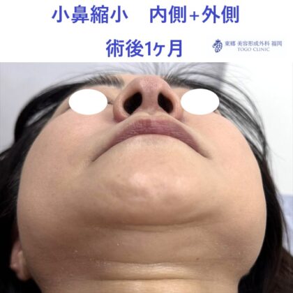 MI　小鼻縮小　術後 (2)