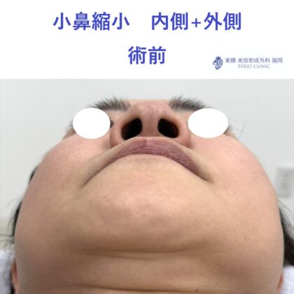 MI　小鼻縮小　術前 (2)