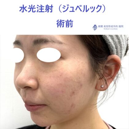 RKジュベルック　術前 (1)