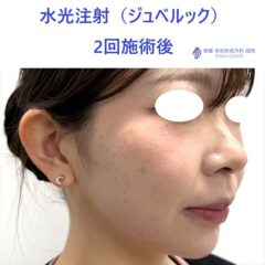 RKジュベルック　術後