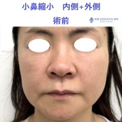 MI　小鼻縮小　術前