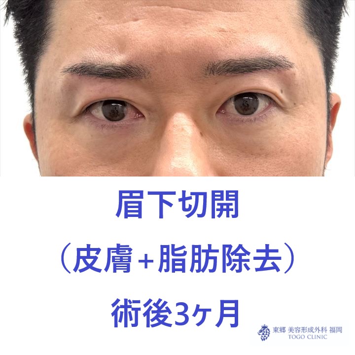 AT眉下　術後
