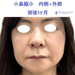 MI　小鼻縮小　術後