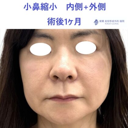 MI　小鼻縮小　術後