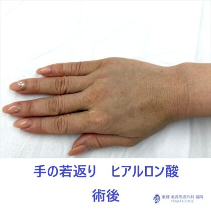 KT　手HA　術後