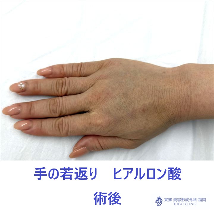 KT　手HA　術後