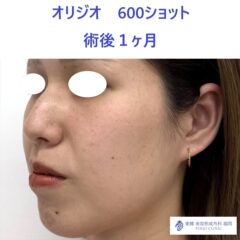 AY　オリジオ術後