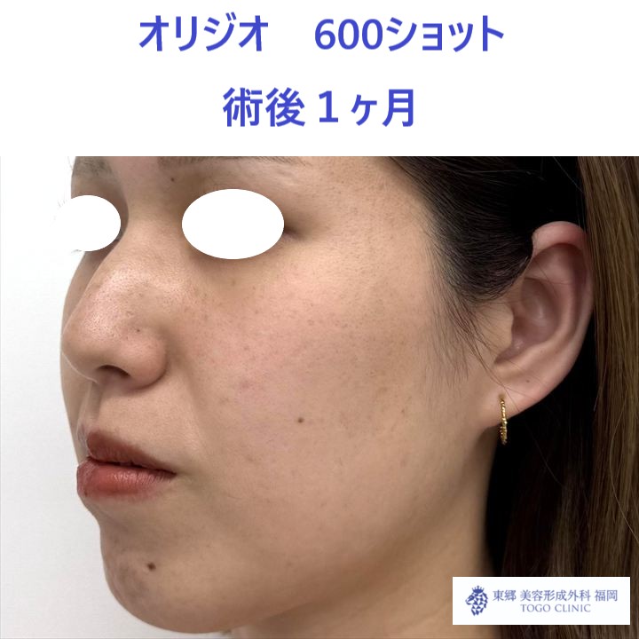 AY　オリジオ術後