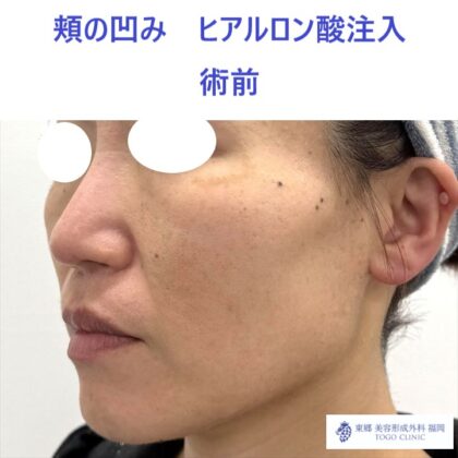 MO　頬HA術前 (2)