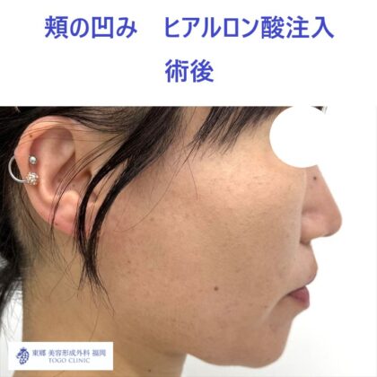 MO　頬HA術後 (3)