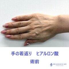 KT　手HA　術前