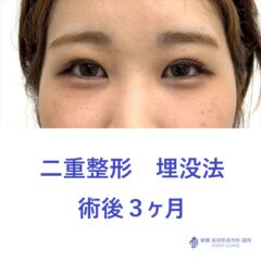 YY　埋没法　術後３M