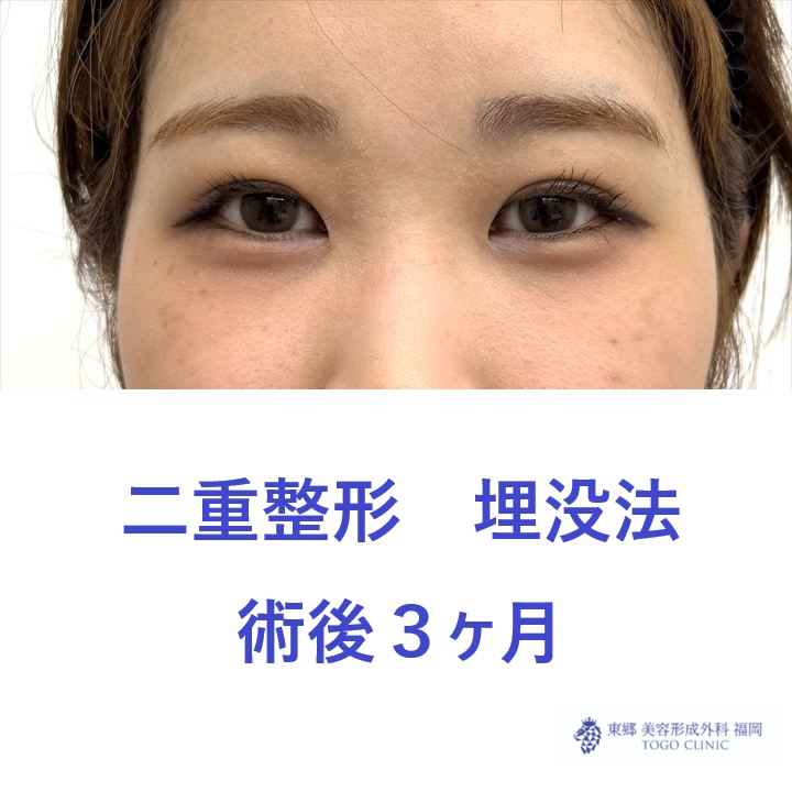 YY　埋没法　術後３M