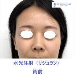 SK 水光リジュラン 術前