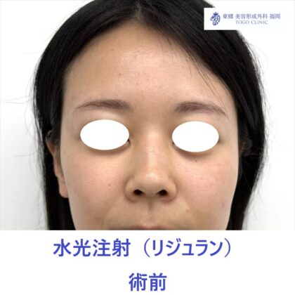 SK　水光リジュラン　術前