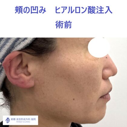 MO　頬HA術前 (3)
