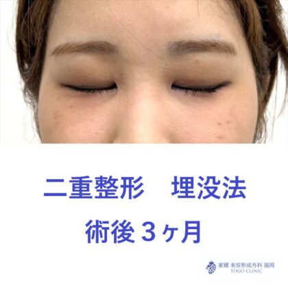 YY　埋没法　術後３M (2)