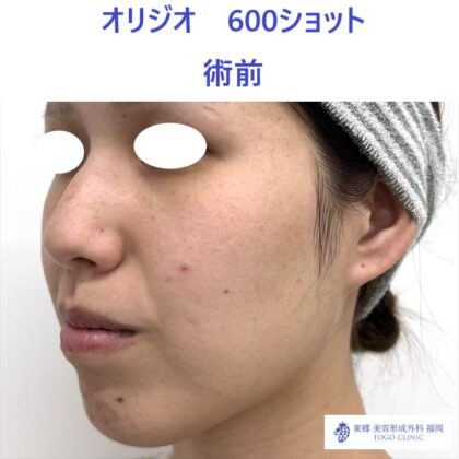 AY　ｵﾘｼﾞｵ術前